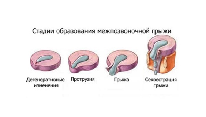 disk_hernia