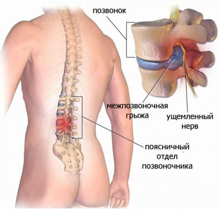 vozniknovenie-mezhpozvonochnoy-grizhi-poyasnichnogo-otdela